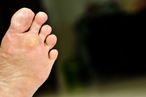 What is Hyperhidrosis?