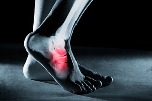 Walking on a Foot Stress Fracture
