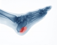 Heel Spurs: The Body’s Response to Stress on Ligaments and Tendons