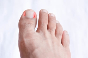 How to Deal With an Ingrown Toenail 