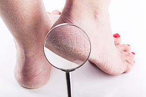 Home Remedy for Cracked Heels