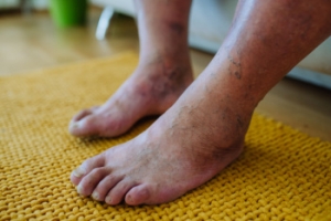 Podiatrist’s Role in Diabetic Limb Salvage