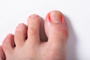 Babies Can Get Ingrown Toenails