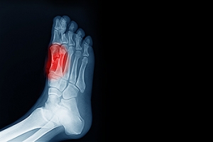 How Long Does It Take for Sesamoiditis to Heal?
