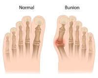 Can Orthotics Help With Bunions?