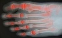 How the Foot Is Affected by Rheumatoid Arthritis