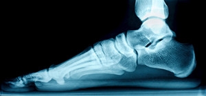 What Are Different Methods for Treating Flat Feet?